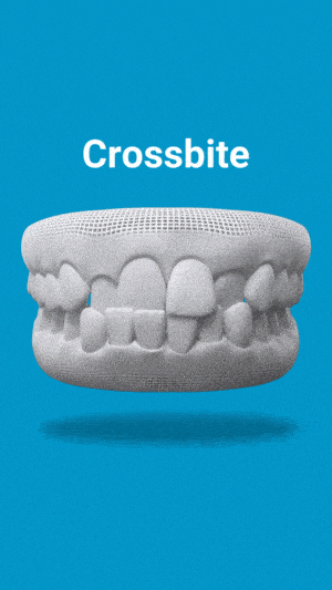 3D dental model showing crossbite malocclusion on blue background with "Crossbite" text label.