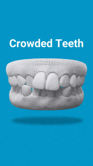3D dental model showing crowded teeth misalignment on blue background with white text label.