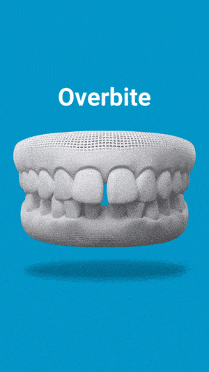 Dental model showing overbite malocclusion on blue background with label.