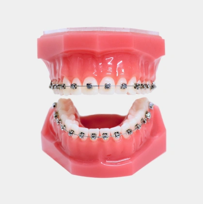 Pink orthodontic model displaying upper and lower teeth with metal braces and brackets attached.