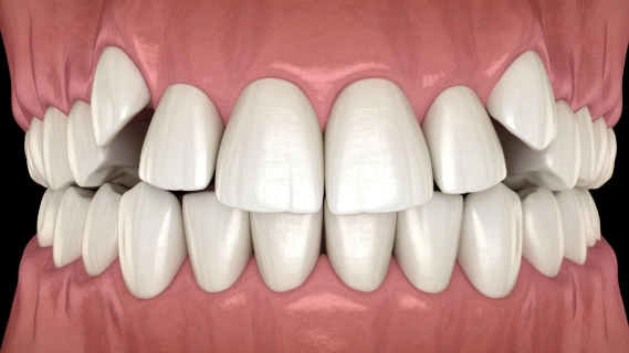 Digital model of white dental crowns and veneers displayed on pink gum tissue model.