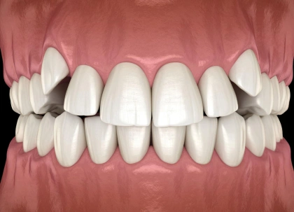Digital model of ideal smile alignment showing white teeth in perfect orthodontic occlusion