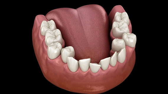 3D model of lower dental arch showing teeth and gum structure for orthodontic education.