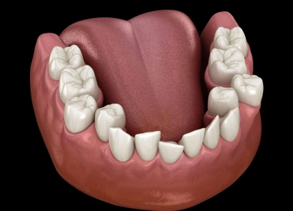 3D dental model showing upper teeth arrangement and bite alignment for orthodontic treatment planning.