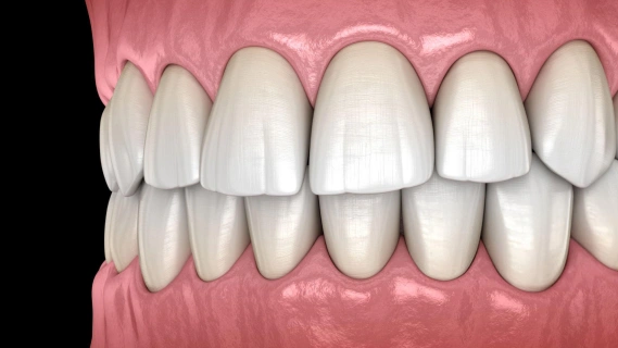 Digital rendering of teeth alignment showing orthodontic results with upper and lower teeth properly positioned against pink gum background.