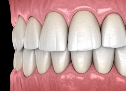 Dental model displaying white teeth alignment on pink gum base for orthodontic reference.