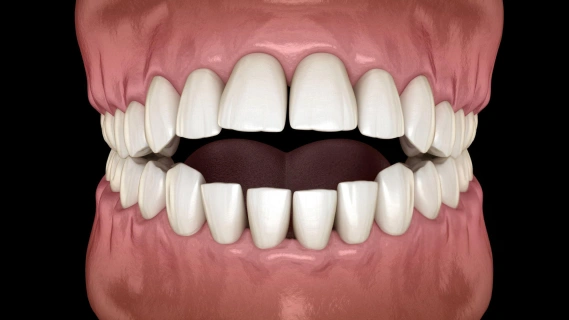 Close-up view of complete set of white dental crowns or veneers on upper and lower teeth against pink gums.