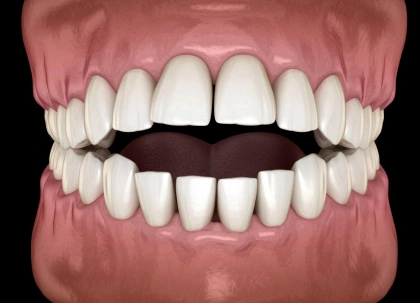 Close-up dental model showing properly aligned upper and lower teeth with pink gums.