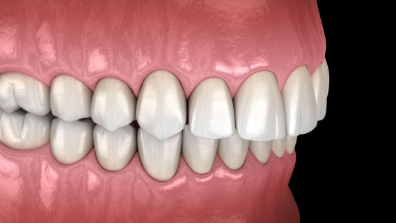 Digital model of aligned white teeth with pink gums showing orthodontic treatment result.