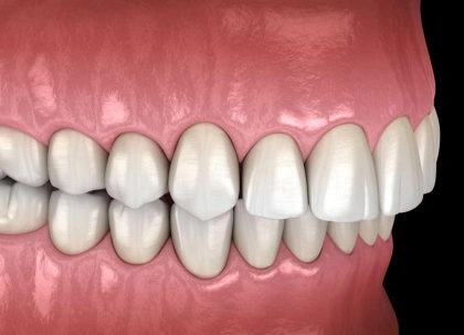 Dental model showing properly aligned white teeth with pink gum tissue in orthodontic display.