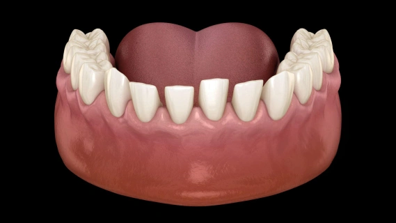 Digital model of upper teeth and gums showing dental restoration or orthodontic treatment result.