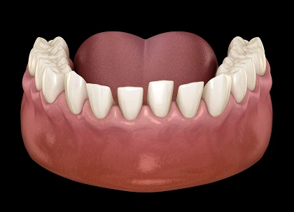 3D dental model showing upper teeth and gum structure against black background.