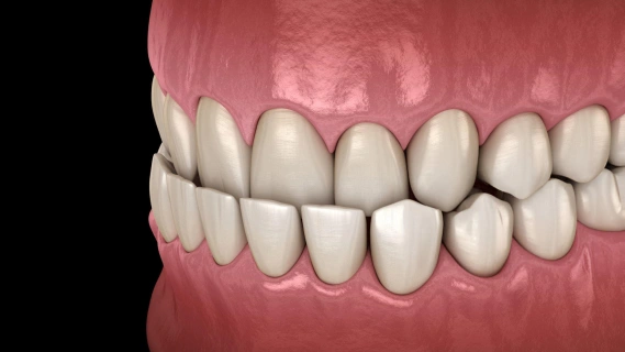 3D dental model showing upper and lower teeth in proper alignment against pink gum tissue.