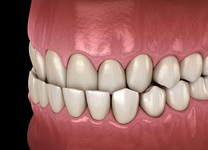 3D dental model showing properly aligned upper and lower teeth with pink gum tissue.