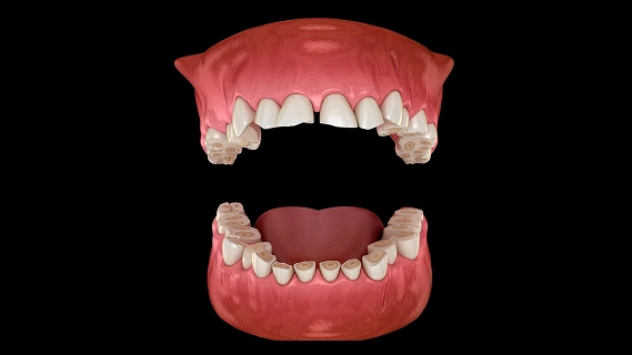 3D dental model showing upper and lower teeth alignment for orthodontic treatment planning.