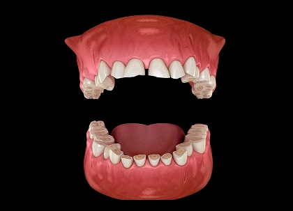 Digital 3D model of upper and lower dental arches showing teeth alignment and gum structure.